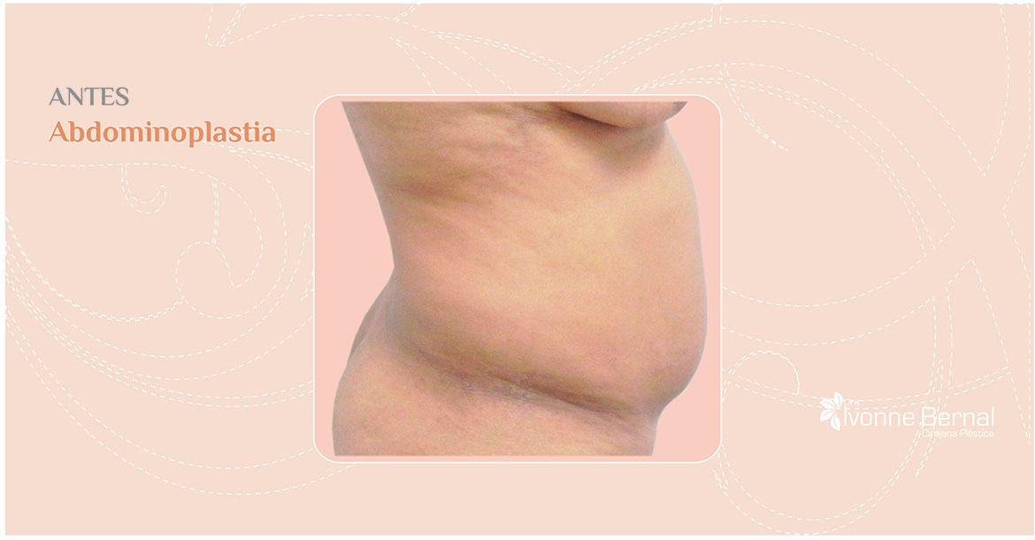 Before-Abdominoplastia