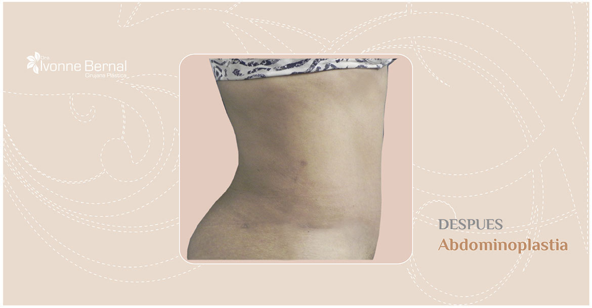 After-Abdominoplastia