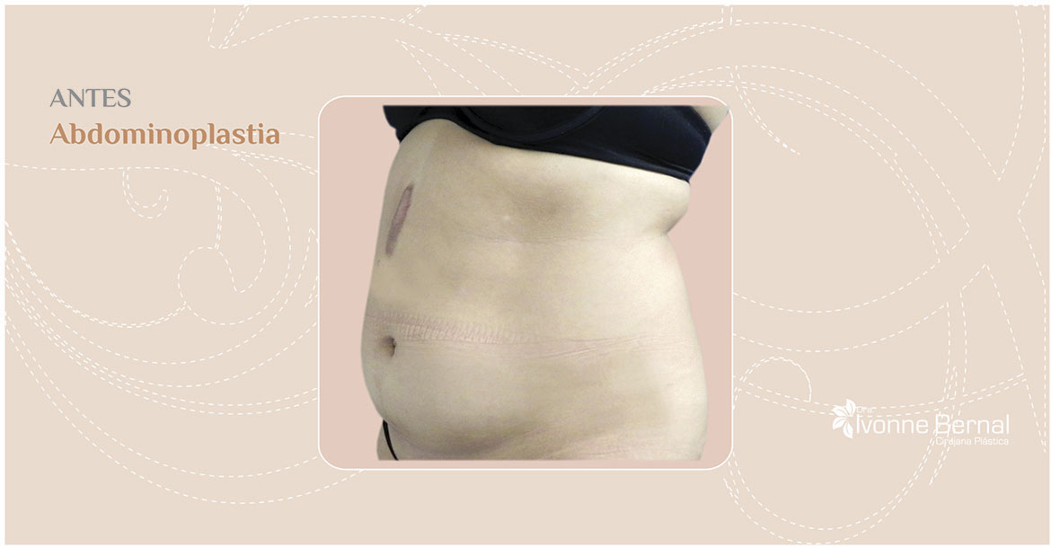 Before-Abdominoplastia