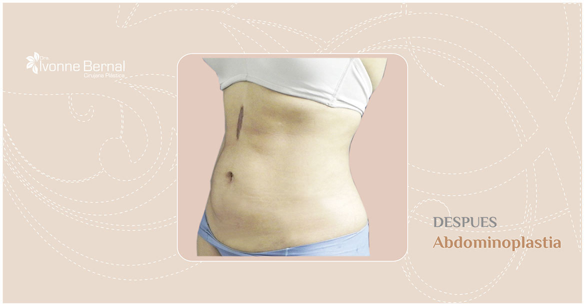 After-Abdominoplastia