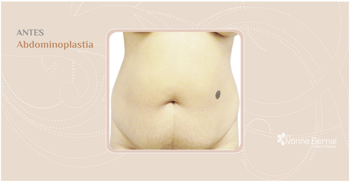 Before-Abdominoplastia