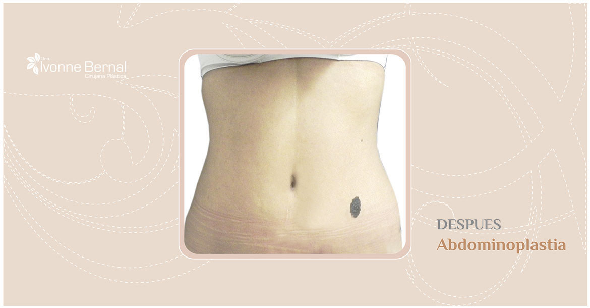 After-Abdominoplastia