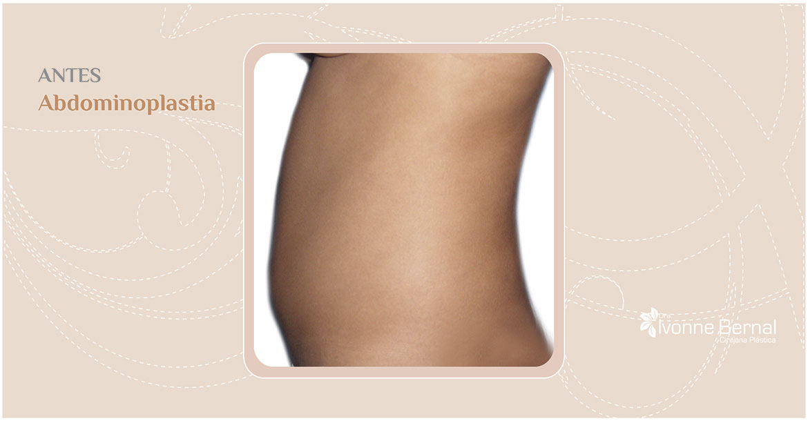 Before-Abdominoplastia