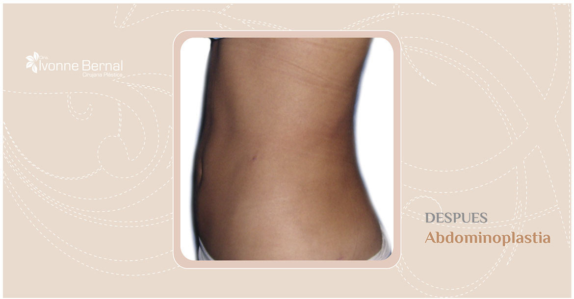 After-Abdominoplastia