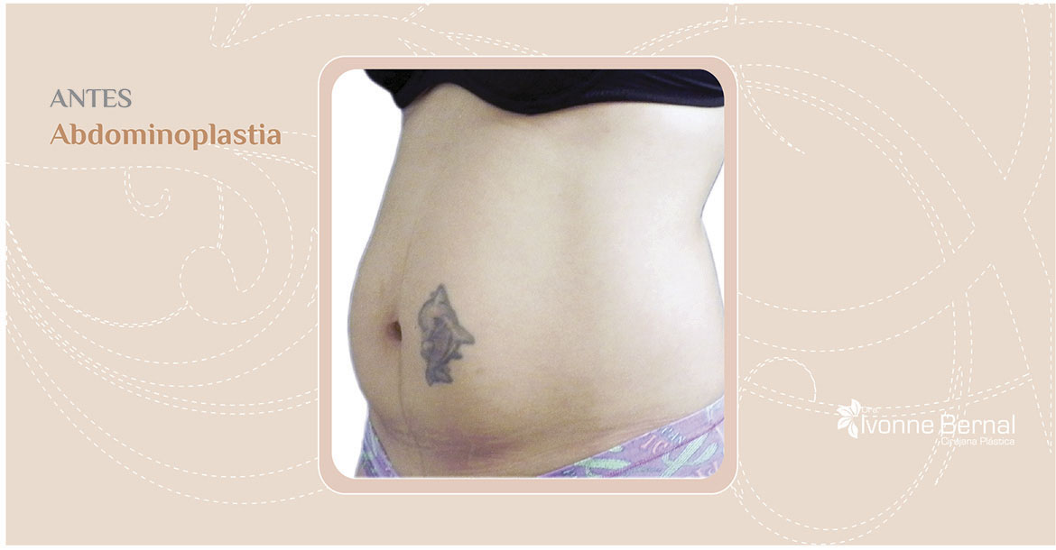 Before-Abdominoplastia