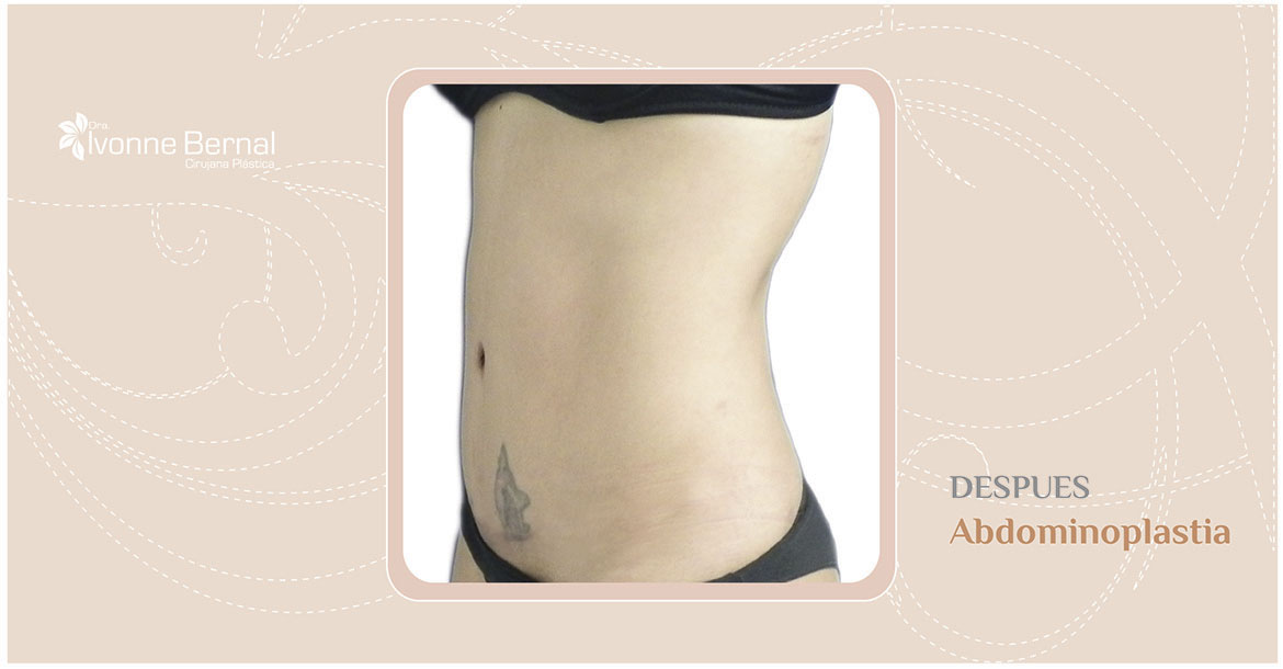 After-Abdominoplastia