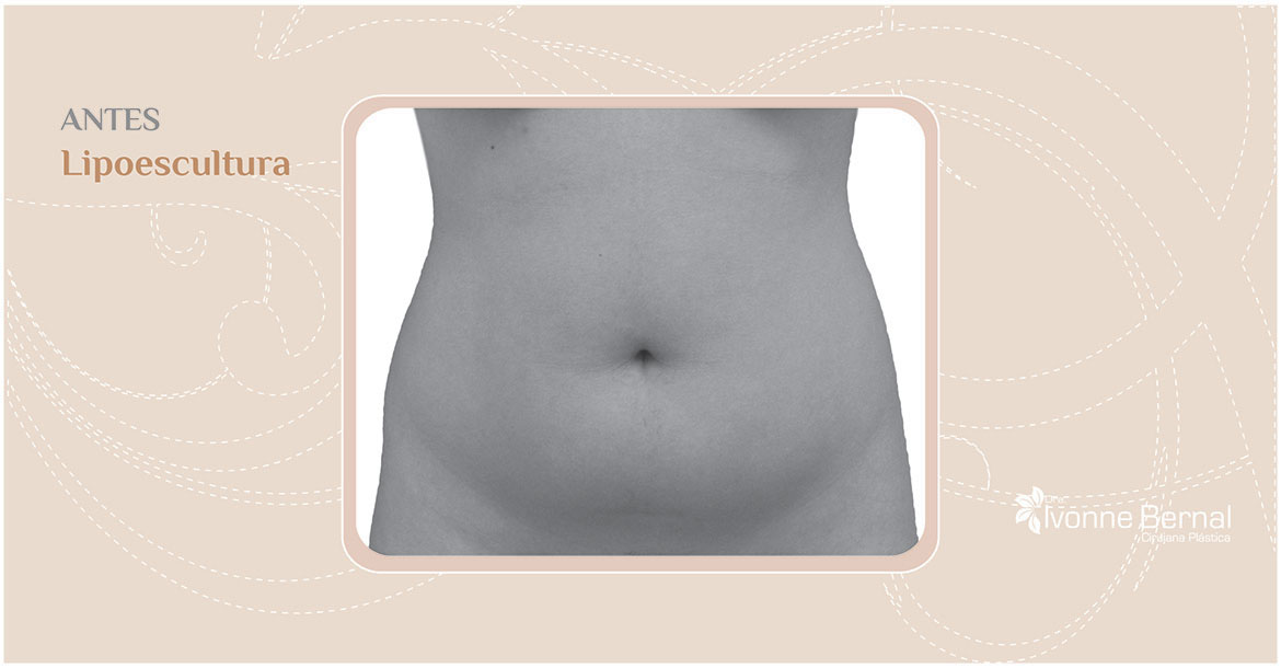 Before-Abdominoplastia