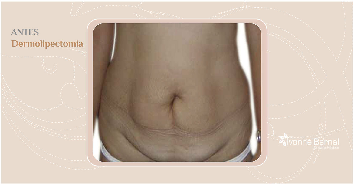 Before-Dermolipectomia