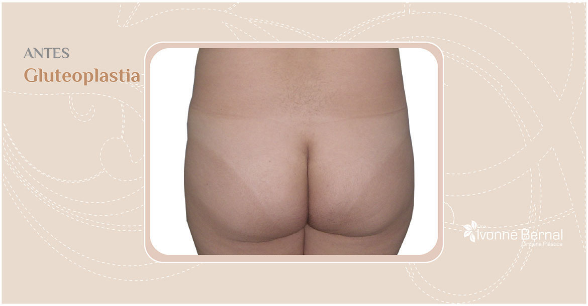 Before-Gluteoplastia