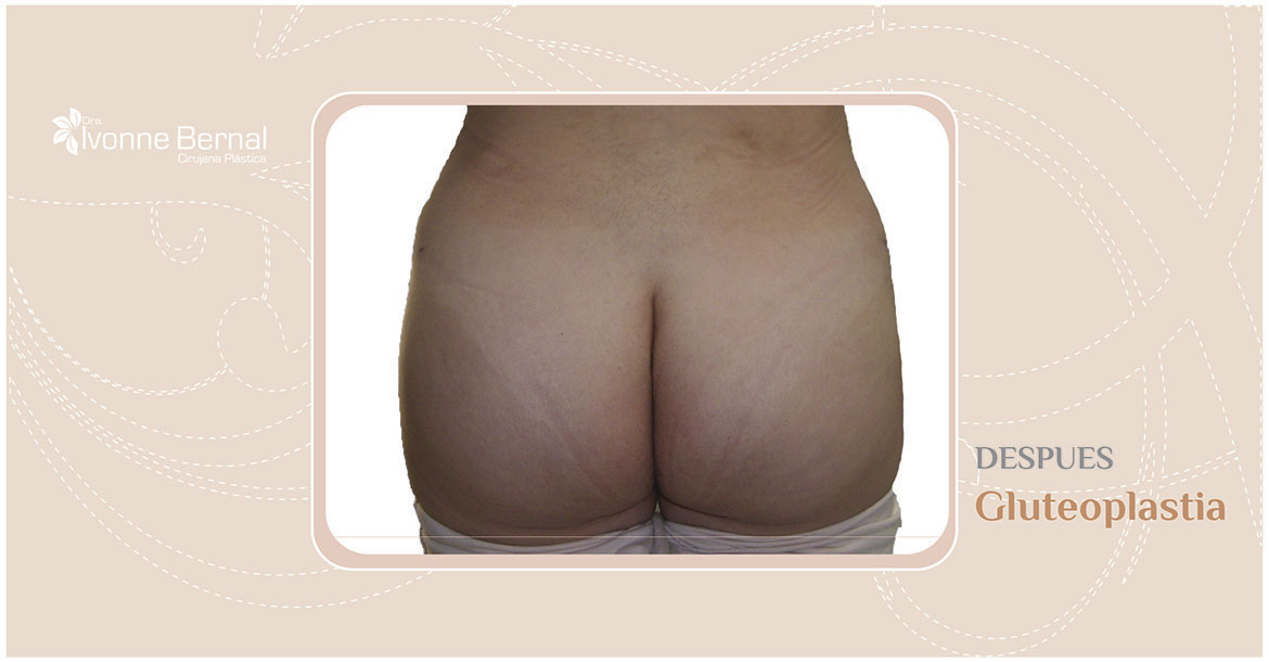 After-Gluteoplastia