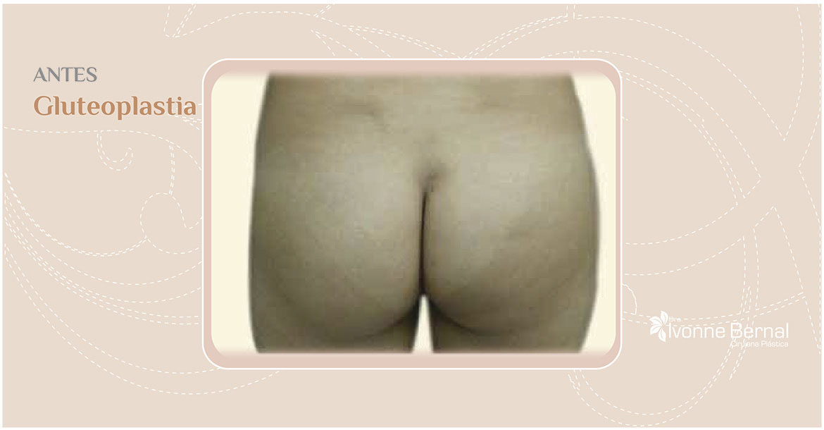 Before-Gluteoplastia