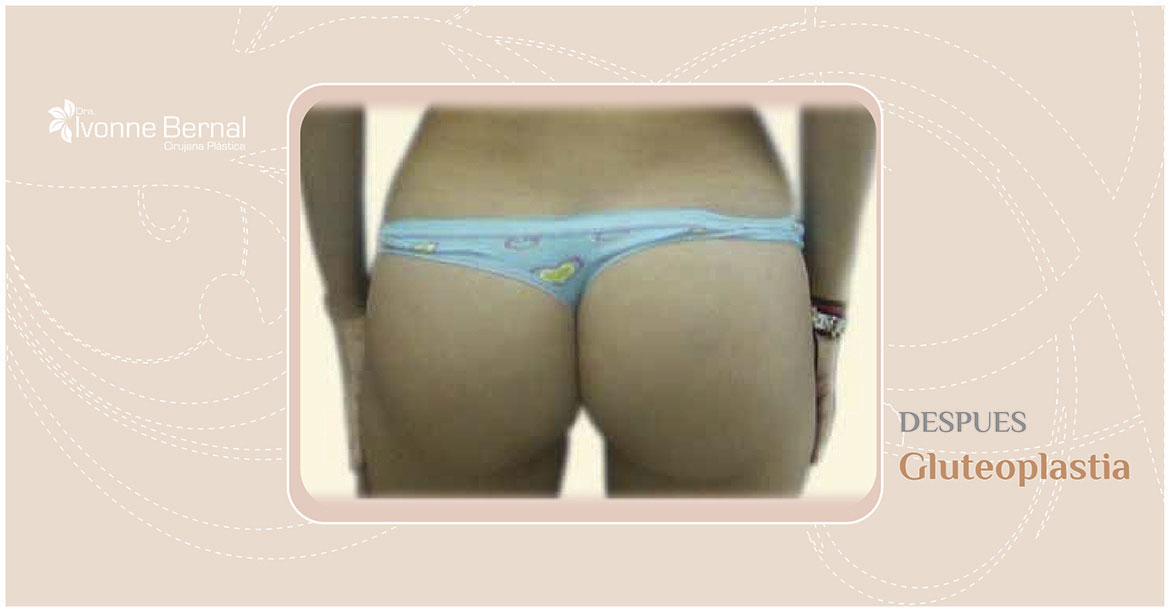 After-Gluteoplastia