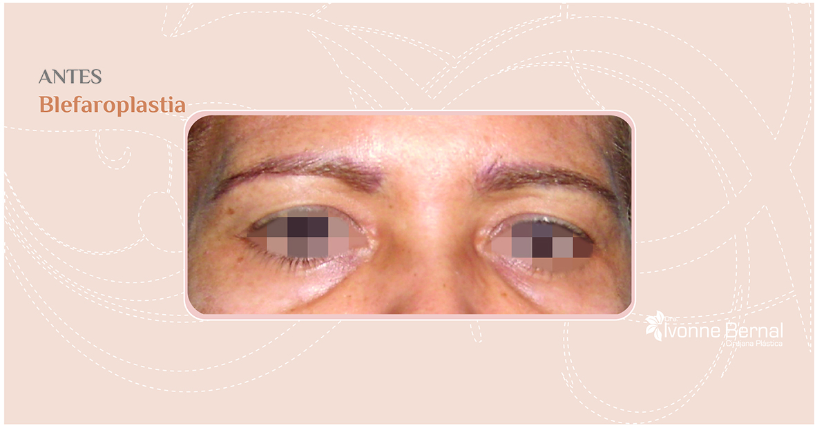 Before-Blefaroplastia