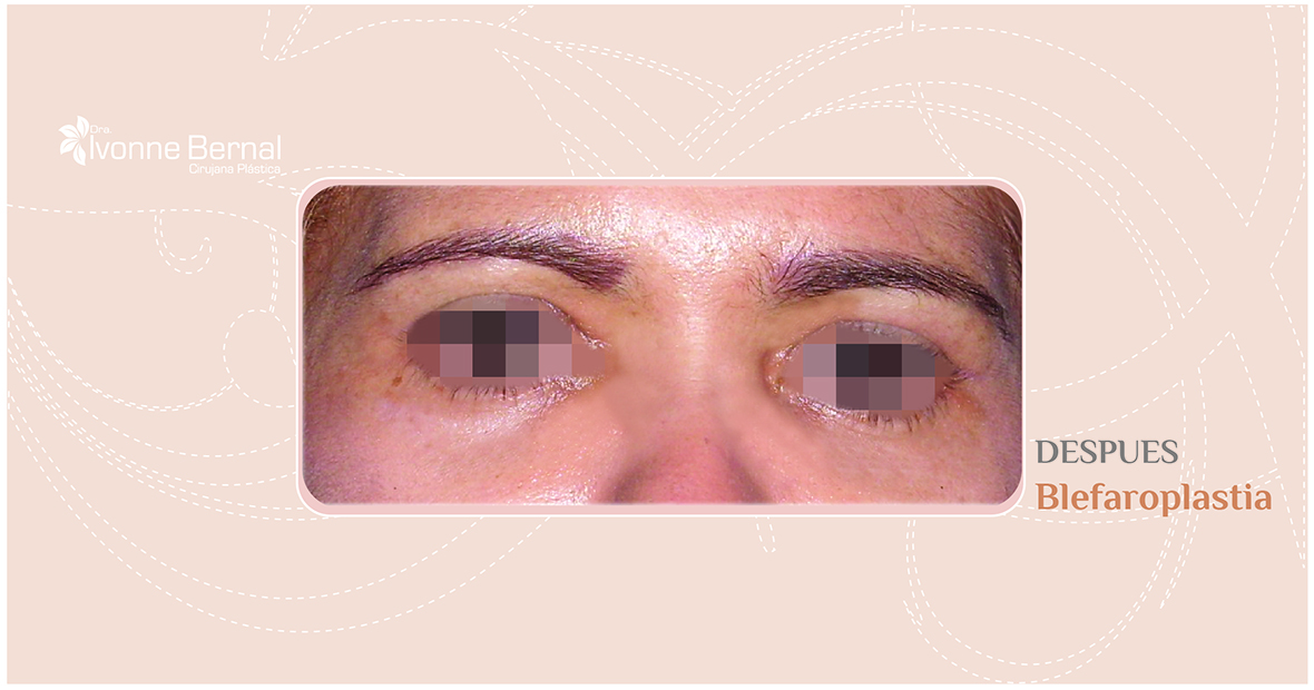 After-Blefaroplastia