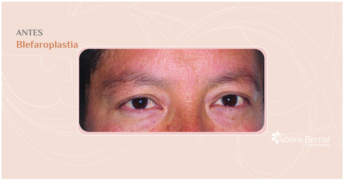 Before-Blefaroplastia