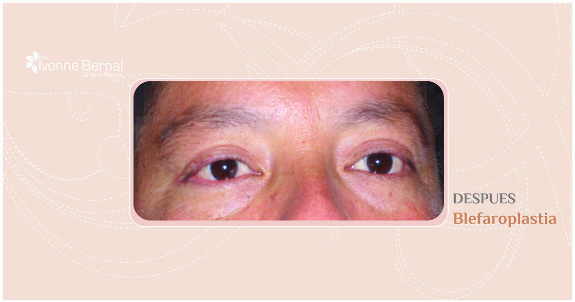 After-Blefaroplastia