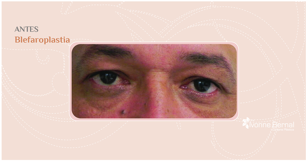 Before-Blefaroplastia