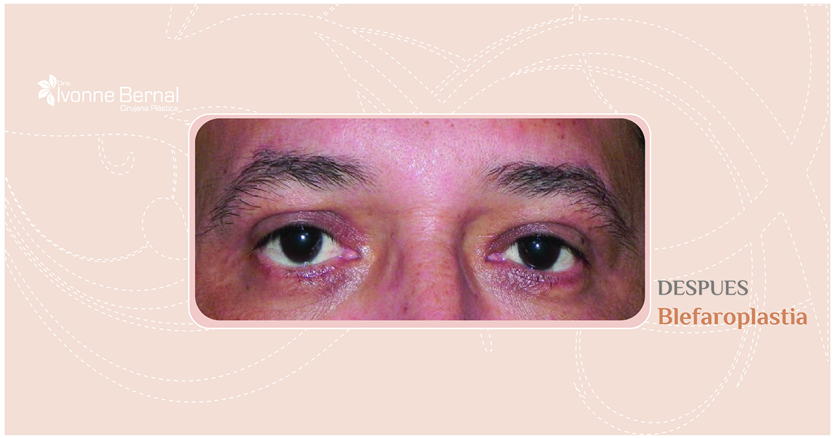 After-Blefaroplastia