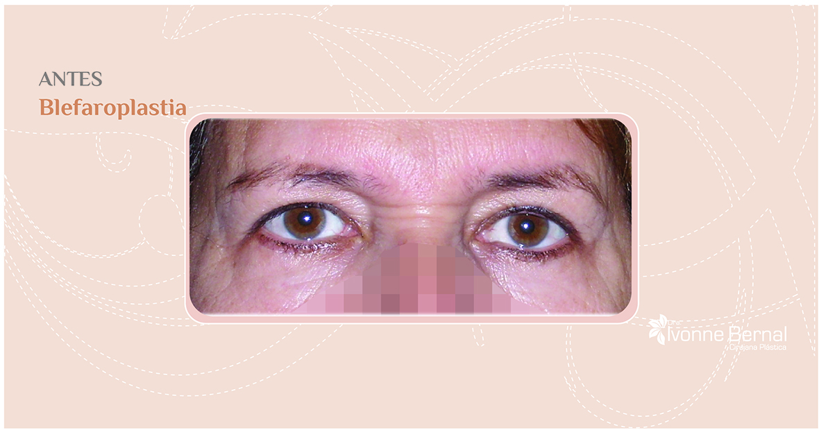 Before-Blefaroplastia