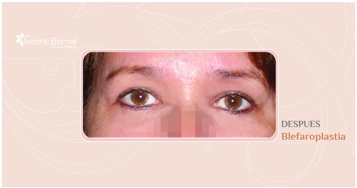 After-Blefaroplastia