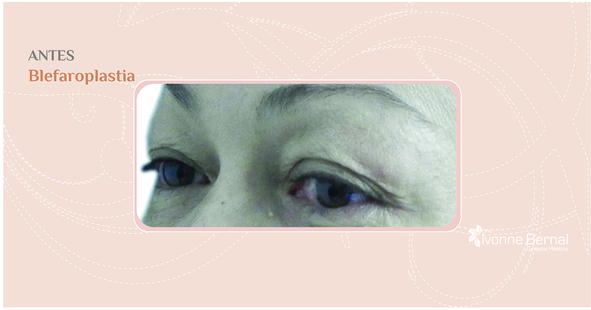 Before-Blefaroplastia