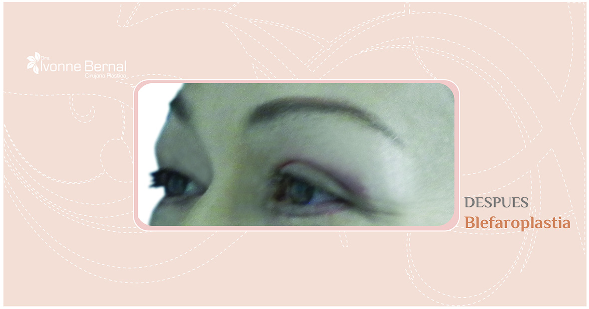 After-Blefaroplastia