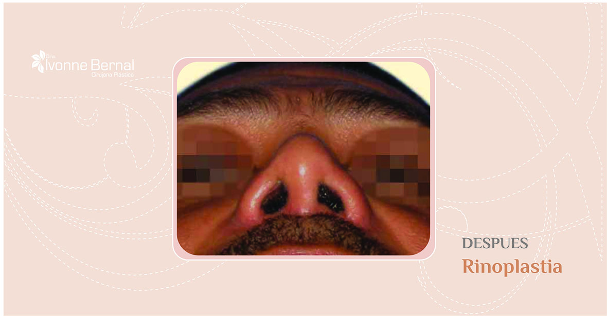 After-Rinoplastia