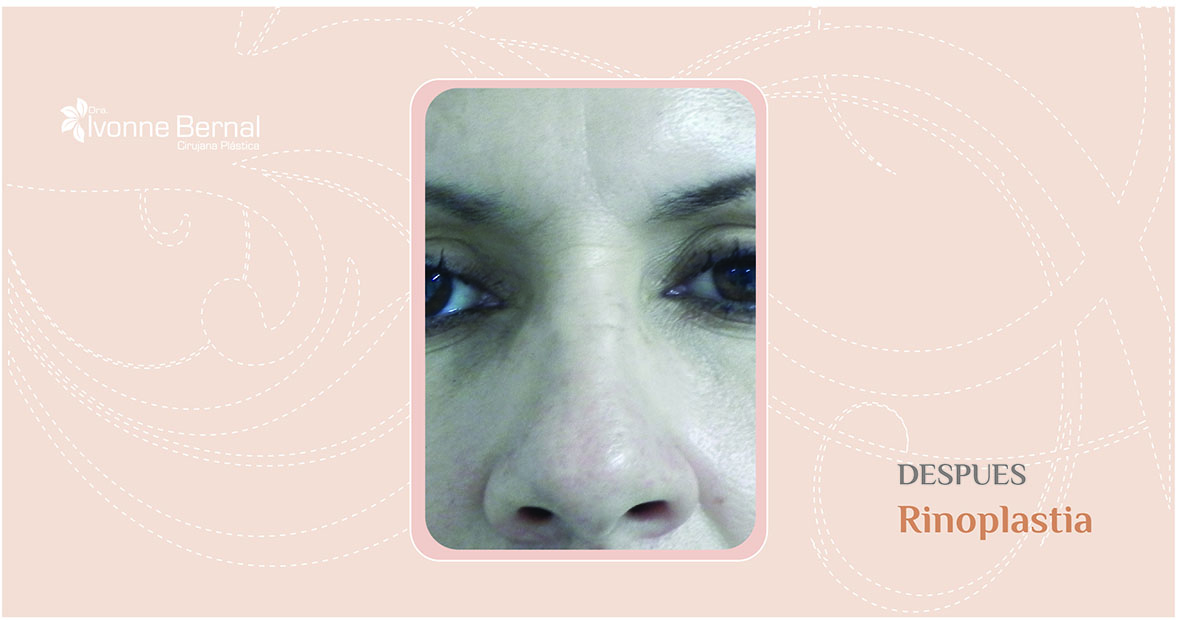 After-Rinoplastia