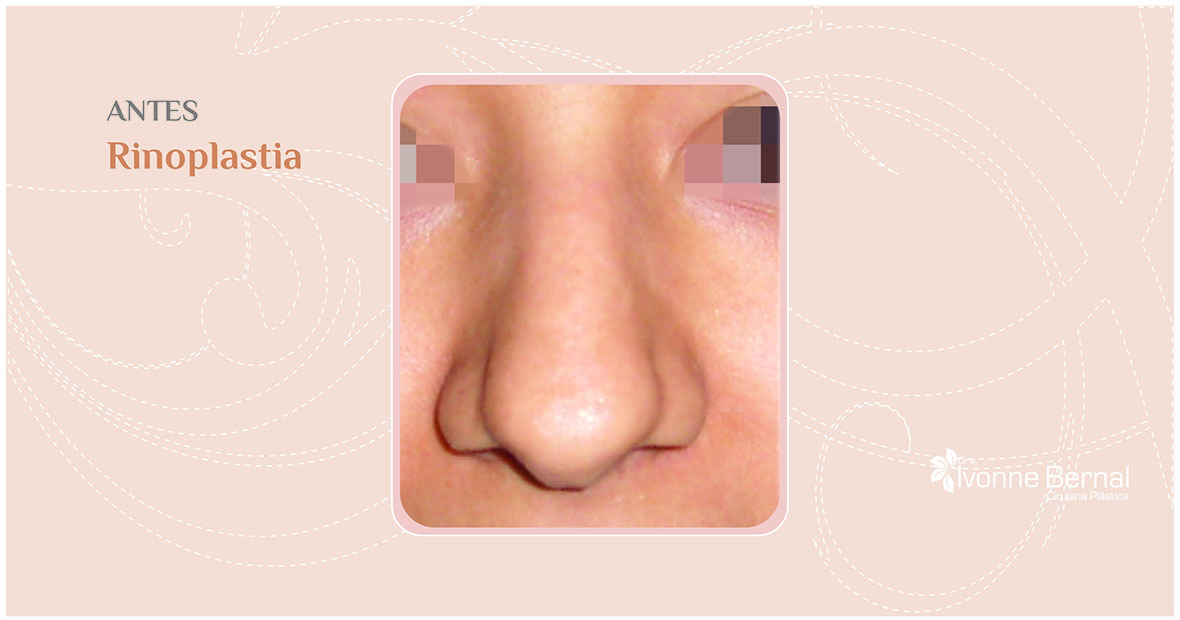 Before-Rinoplastia