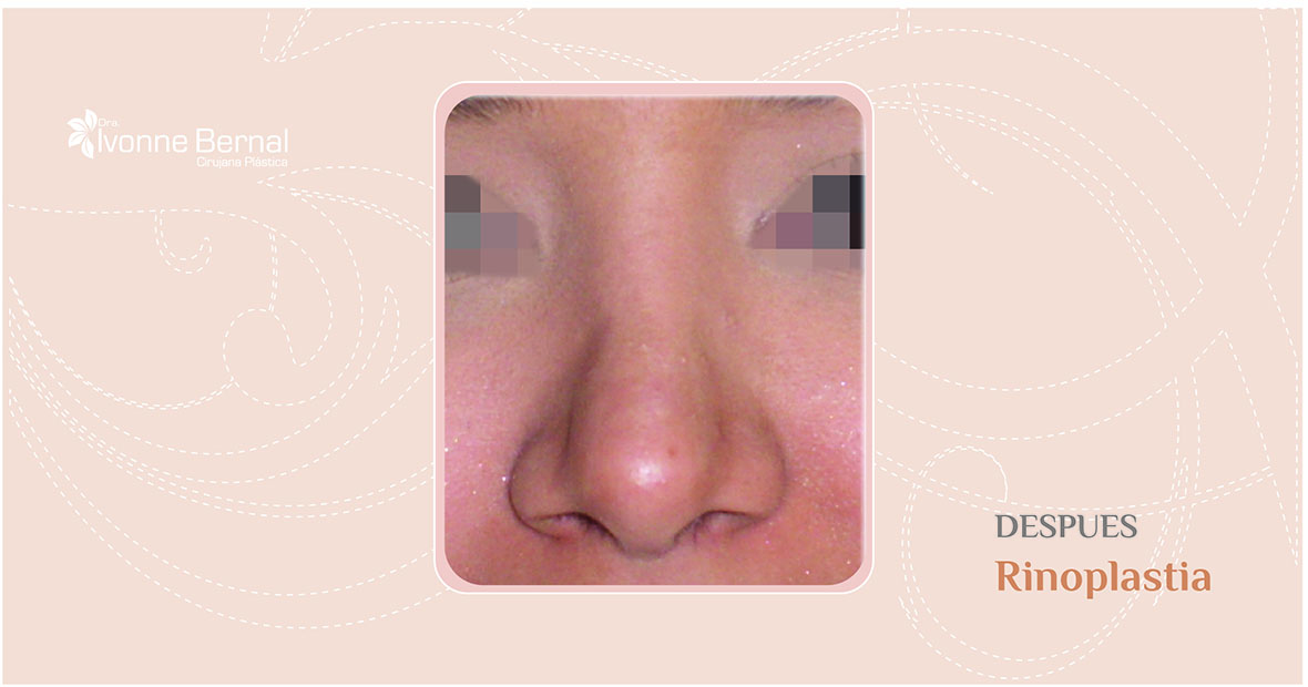 After-Rinoplastia